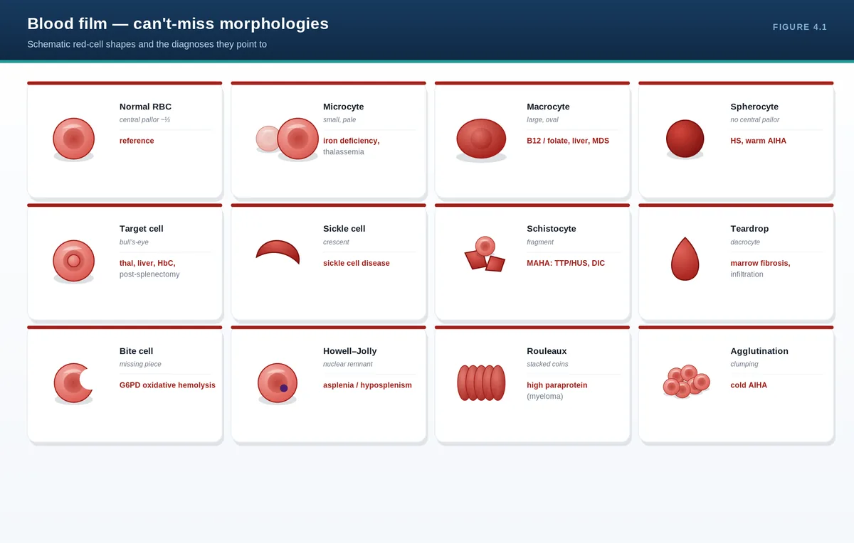 Blood film — can't-miss morphologies
