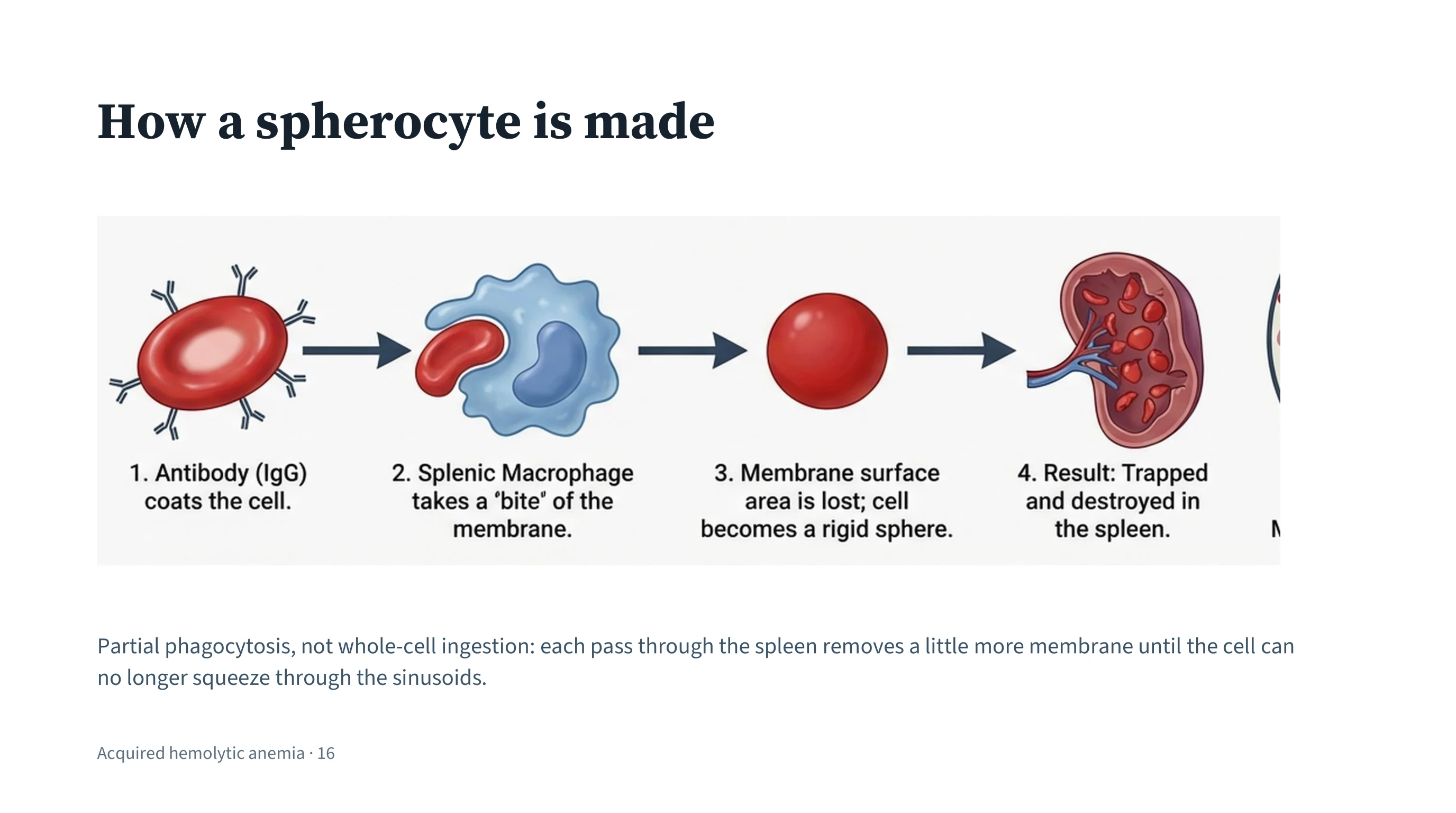 A wide four-panel sequence read left to right, joined by arrows: an antibody-coated red cell; a splenic macrophage removing part of its membrane; the cell now a smooth rigid sphere; and the sphere retained in the spleen. A caption beneath explains partial phagocytosis.