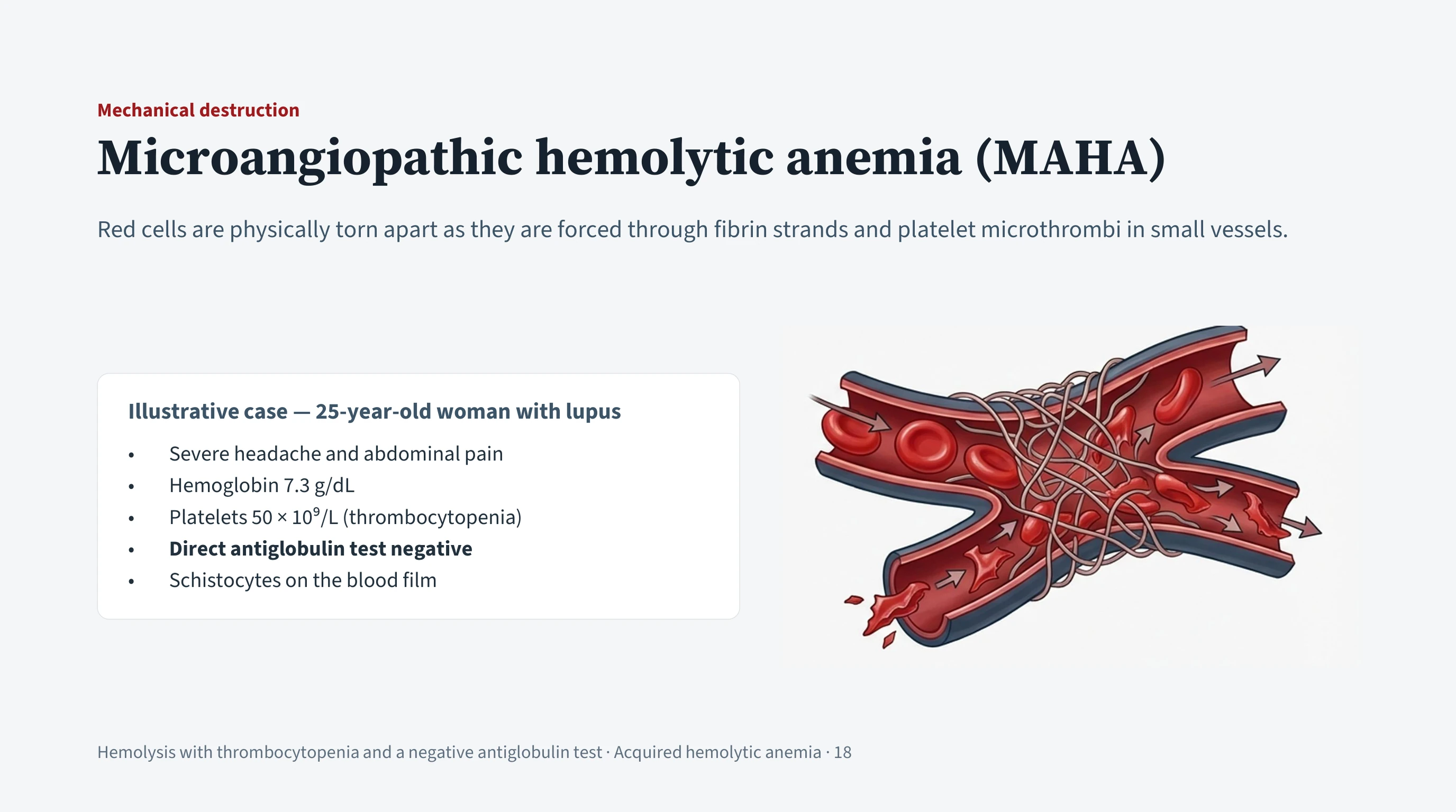 Left, a definition of microangiopathic hemolytic anemia above a boxed case summary of a 25-year-old woman with lupus, listing her presentation and five findings. Right, an illustration of a blood vessel crossed by fibrin strands with red cells being torn apart against them.