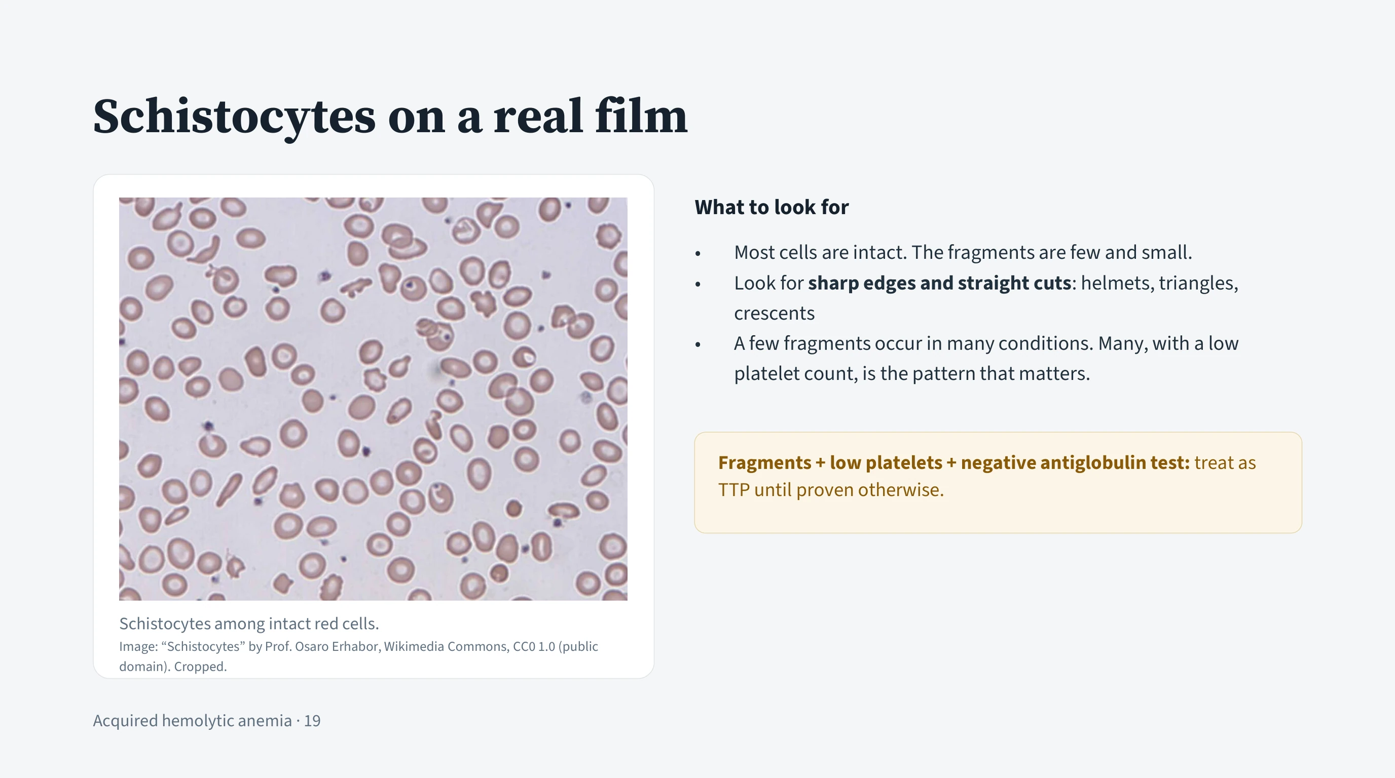 Left, a photograph of a real blood film: mostly intact round and oval red cells, with scattered small irregular fragments with sharp edges, captioned with the image credit. Right, three points on what to look for and a note box: fragments with low platelets and a negative antiglobulin test are TTP until proven otherwise.