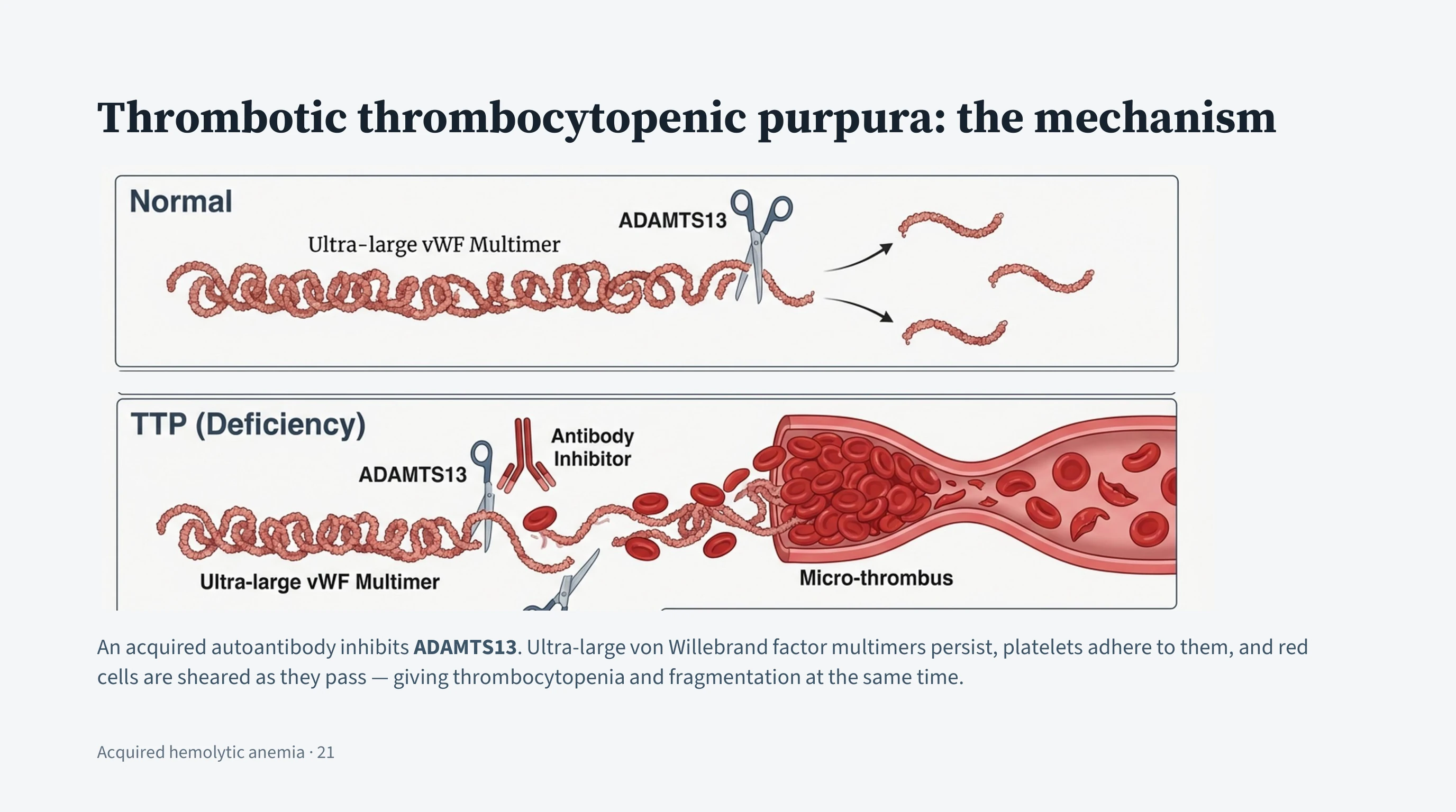 Two stacked panels. The upper, headed normal, shows a long coiled von Willebrand factor multimer being cut by a pair of scissors labelled ADAMTS13 into short fragments. The lower, headed TTP, shows an antibody inhibitor blocking the enzyme, the multimer left uncut, and downstream a vessel packed with a platelet micro-thrombus and fragmented red cells passing it.