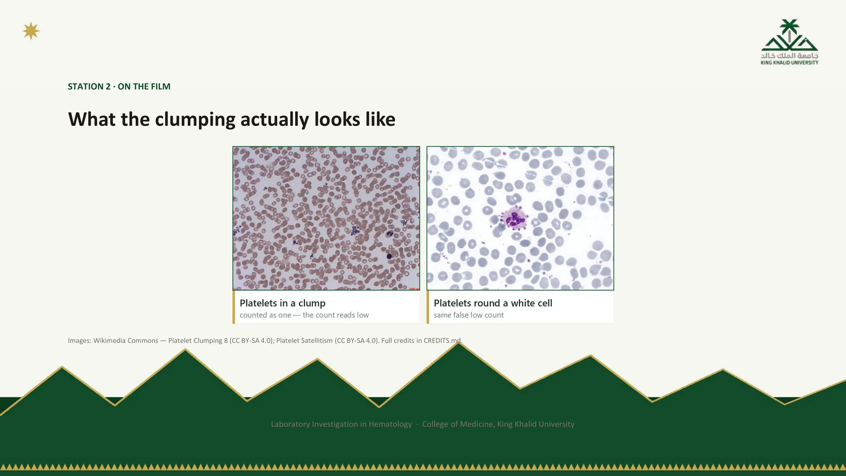 Two photomicrographs: platelets gathered in a clump, counted as one so the count reads low, and platelets rosetted around a white cell, platelet satellitism, which also gives a false low count.