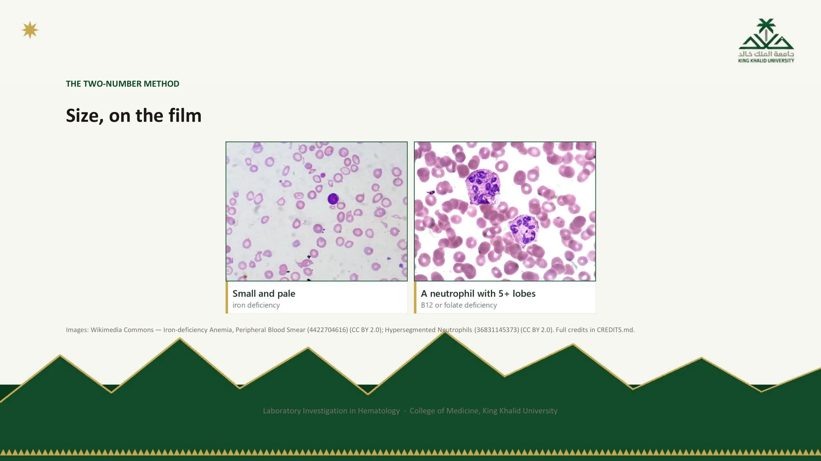 Two photomicrographs: small pale red cells of iron deficiency, and a neutrophil with five or more lobes, a hypersegmented neutrophil, pointing to B12 or folate deficiency.