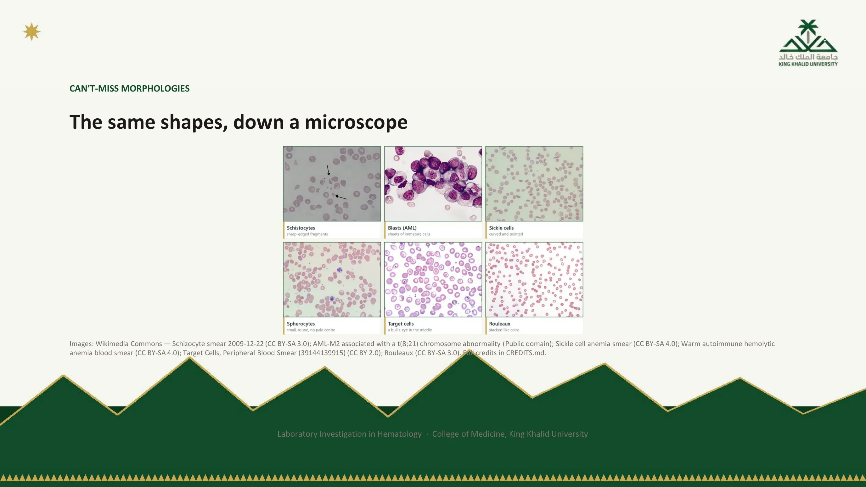 Six photomicrographs labelled with what to look for: schistocytes, blasts of acute myeloid leukemia with an Auer rod, sickle cells, spherocytes, target cells, and rouleaux.