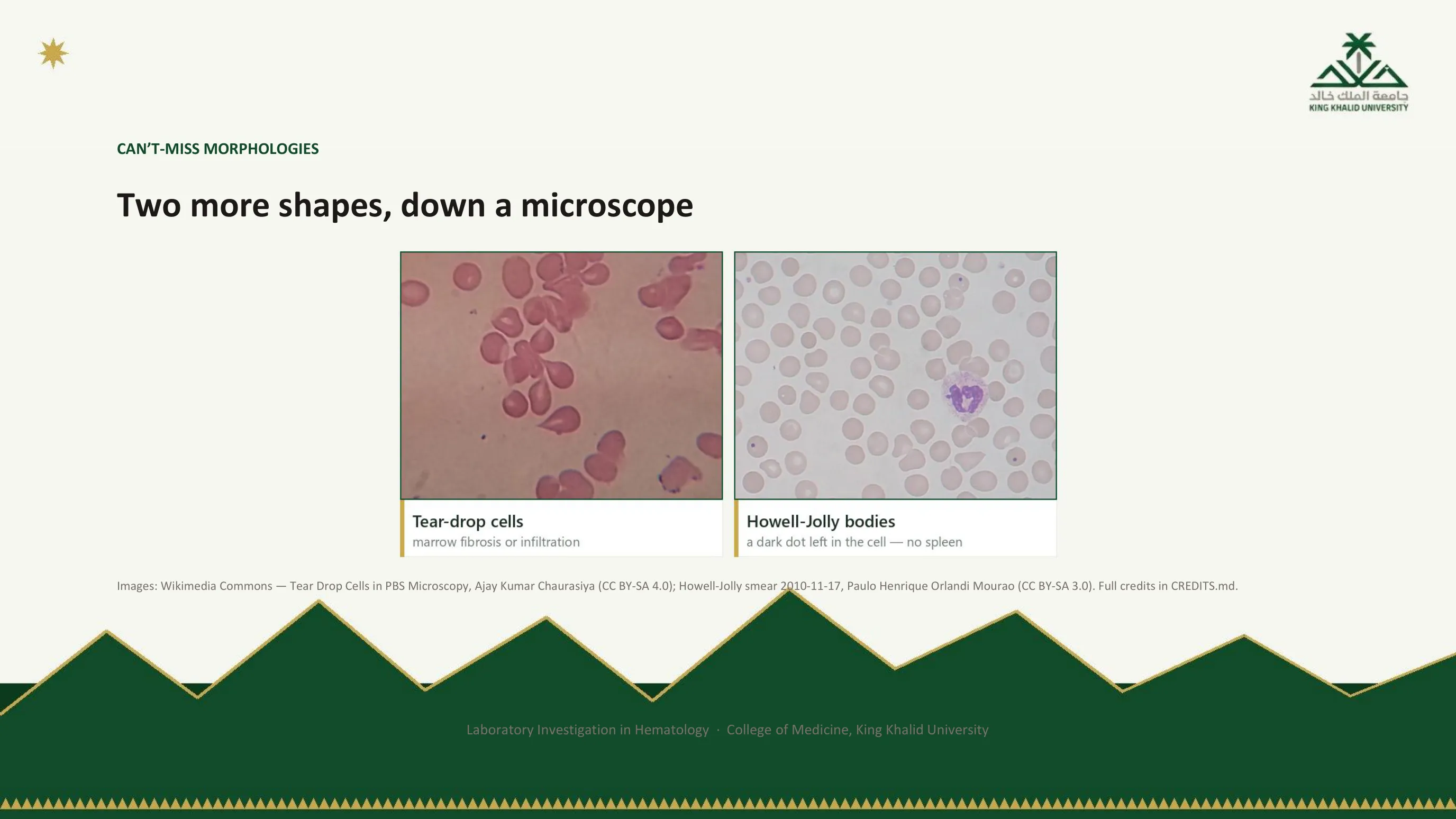 Two photomicrographs: tear-drop shaped red cells, pointing to marrow fibrosis or infiltration; and red cells, three of which carry a single small dark dot, the Howell-Jolly body, pointing to an absent or failing spleen.