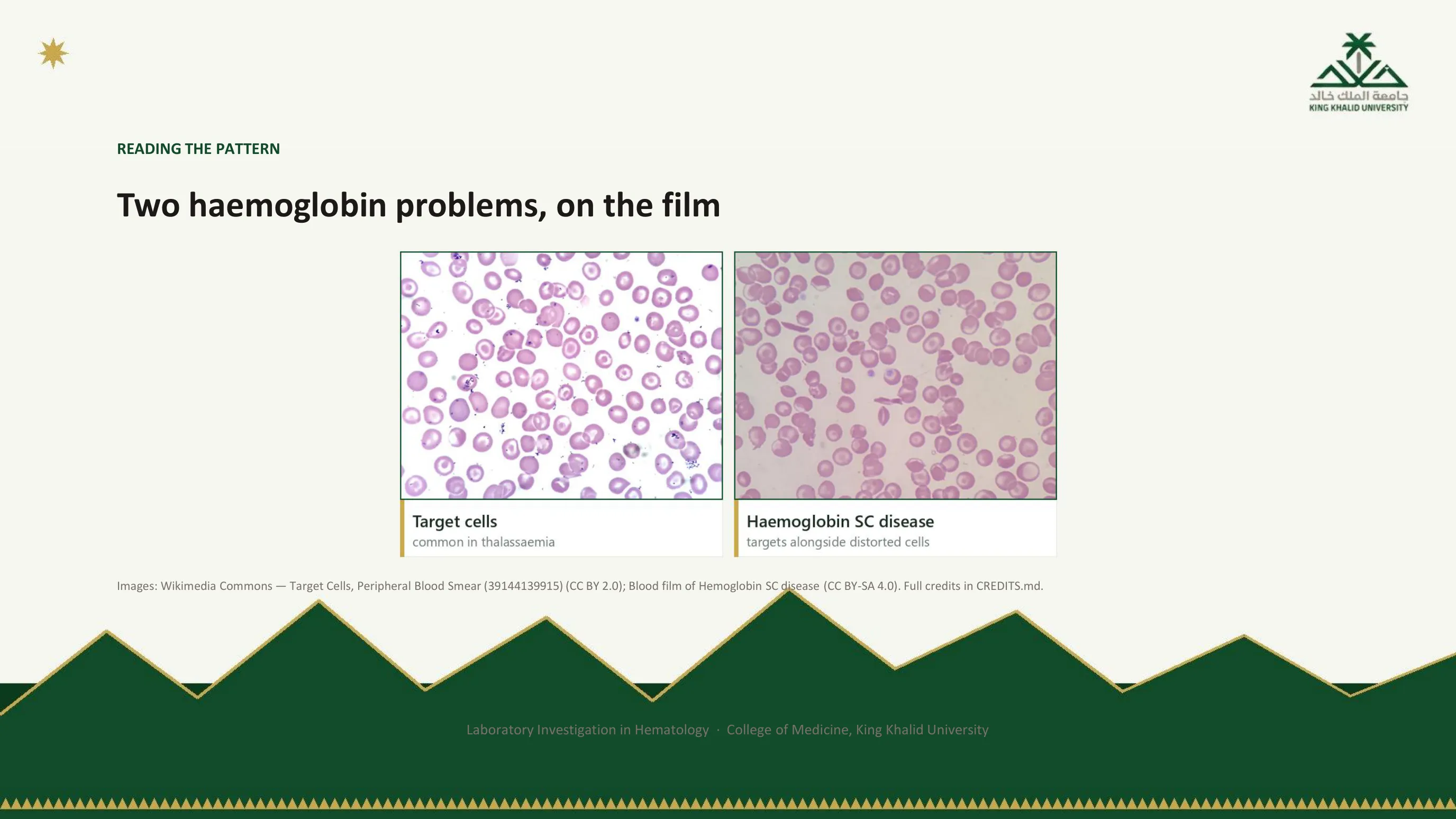 Two photomicrographs: target cells, common in thalassemia, and a film of hemoglobin SC disease with target cells among distorted cells.