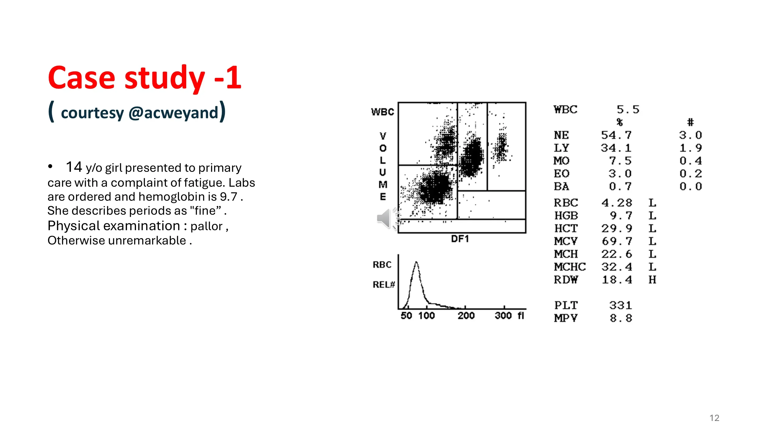 Case study of a 14-year-old girl with fatigue, showing a CBC analyzer scattergram, RBC histogram and a full blood count with microcytic anemia values.