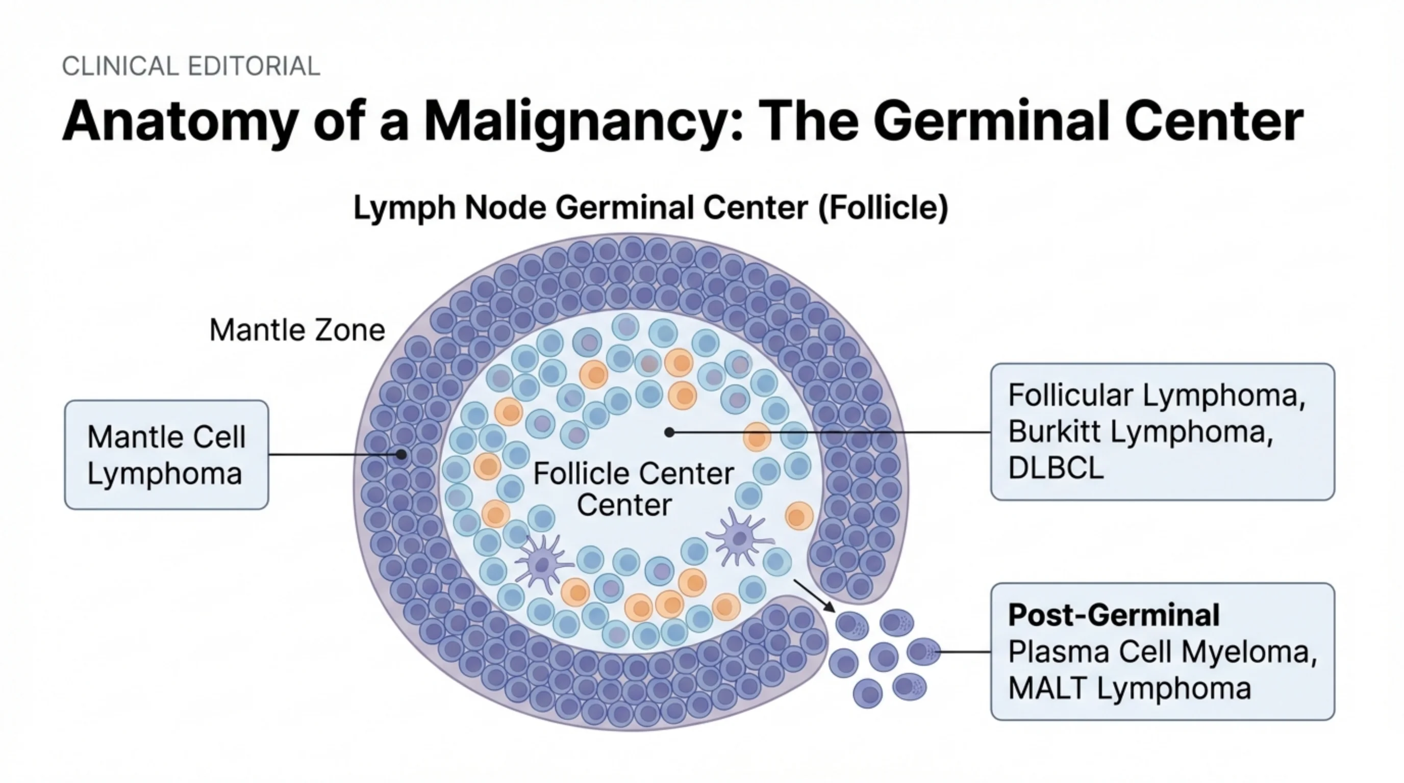 Cross-section diagram of a lymph node follicle showing the mantle zone and follicle center, with callouts linking each zone to the lymphomas that arise there.