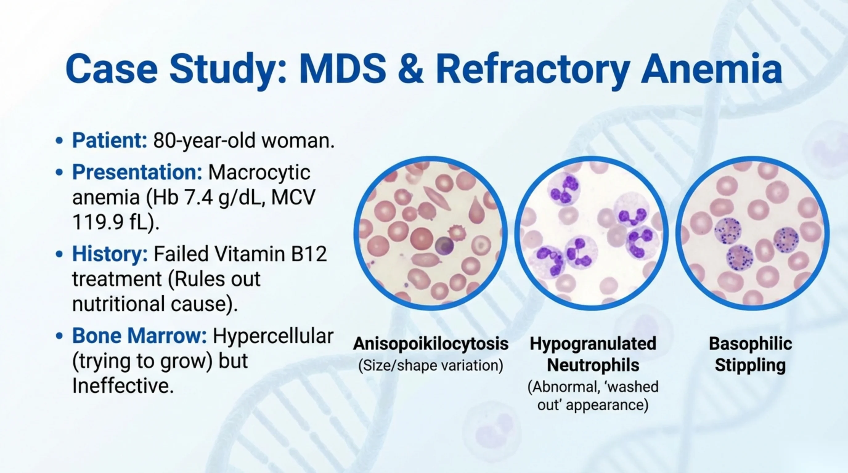 MDS case with three blood-smear micrographs illustrating anisopoikilocytosis, hypogranulated neutrophils, and basophilic stippling.