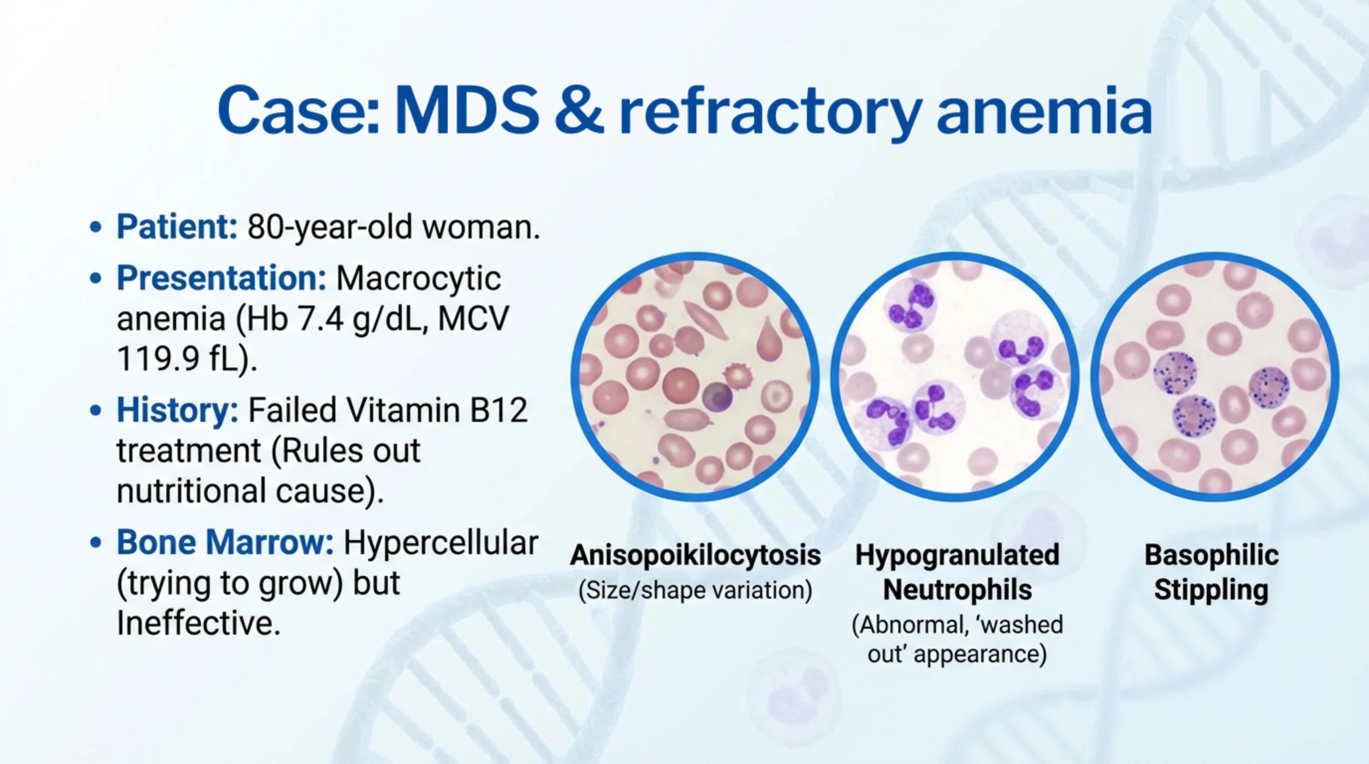 MDS case with three blood-smear micrographs illustrating anisopoikilocytosis, hypogranulated neutrophils, and basophilic stippling.