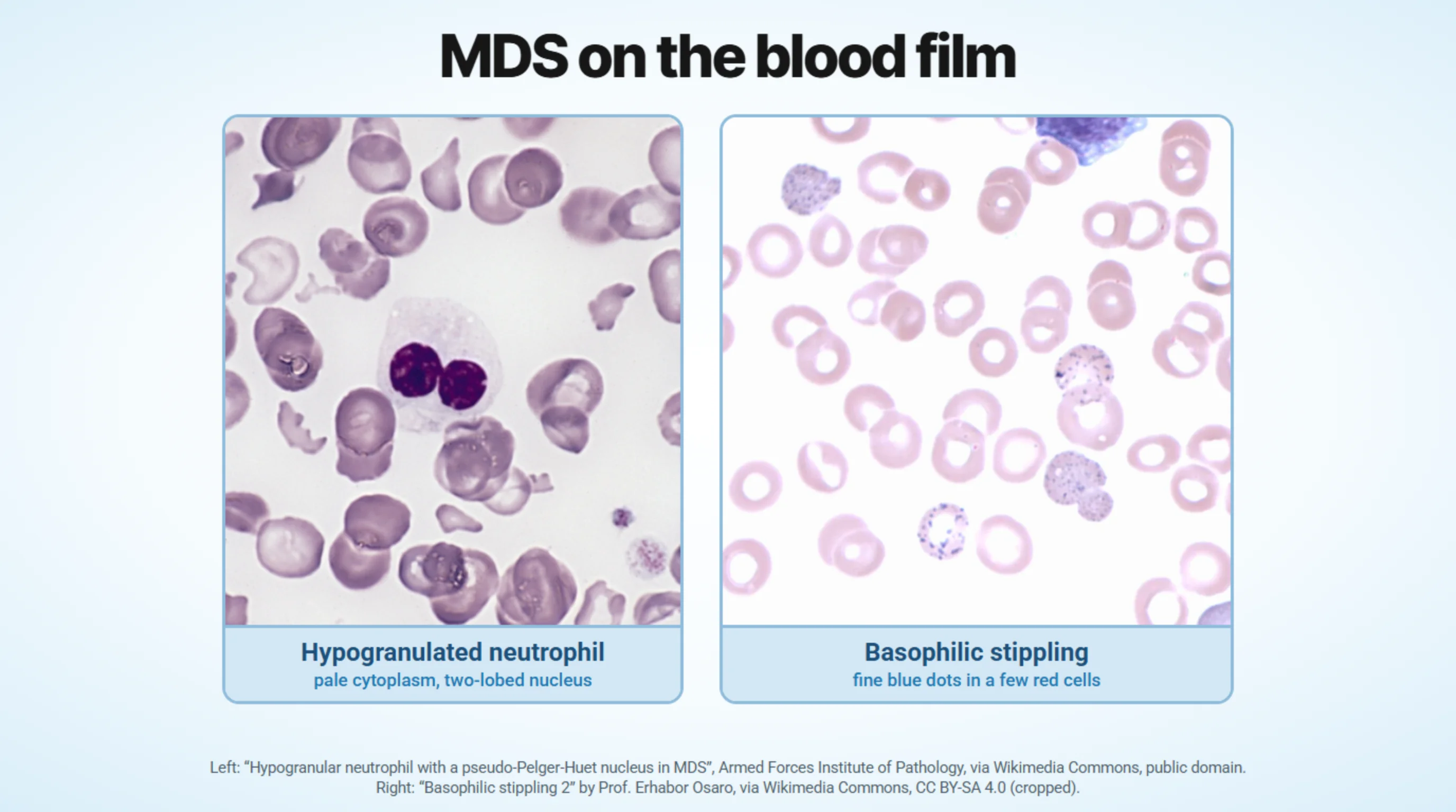 Two photographs of blood films. Left: a neutrophil with pale, almost granule-free cytoplasm and a nucleus of two round lobes, among irregular red cells, captioned hypogranulated neutrophil. Right: red cells, a few of them carrying fine blue dots, captioned basophilic stippling. Attribution: left, Armed Forces Institute of Pathology, via Wikimedia Commons, public domain; right, “Basophilic stippling 2” by Prof. Erhabor Osaro, via Wikimedia Commons, CC BY-SA 4.0, cropped.