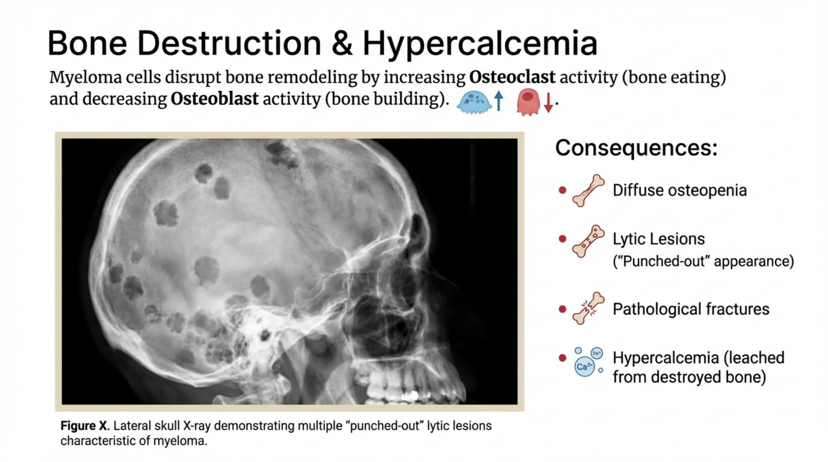Lateral skull X-ray showing multiple punched-out lytic lesions on the left, with a Consequences bullet list on the right.