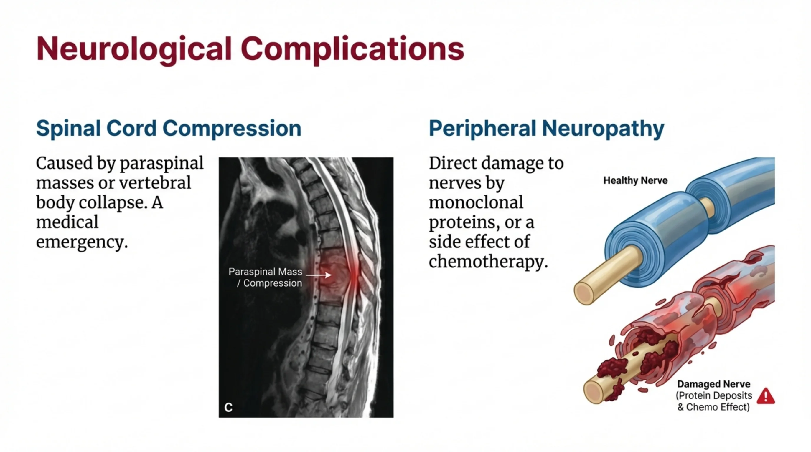 Two-column slide: an MRI of the spine showing a paraspinal mass causing cord compression, and an illustration comparing a healthy nerve with a damaged nerve.