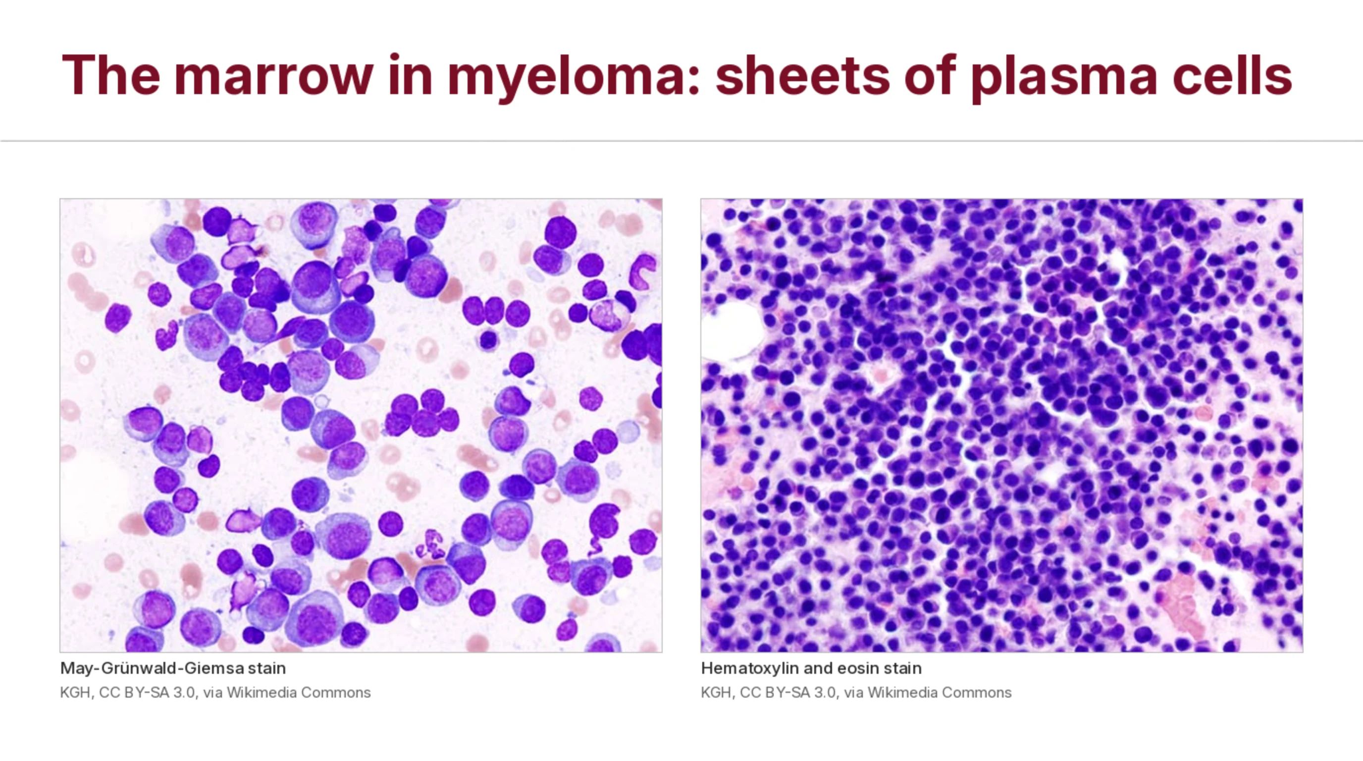 Two photomicrographs of bone marrow from a patient with multiple myeloma. Left, a May-Grünwald-Giemsa stain with many plasma cells with eccentric nuclei and blue cytoplasm. Right, a hematoxylin and eosin stain of the same case, densely packed with cells. Attribution lines: KGH, CC BY-SA 3.0, via Wikimedia Commons.